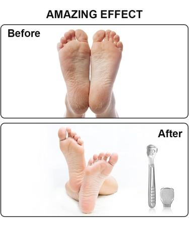 Vokmon Pedicure Hornhauter Set - Professional Foot File with Replacement Blades for Effective Hard Skin Removal | Perfect for Foot & Hand Care - Buy Online on GoSupps.com