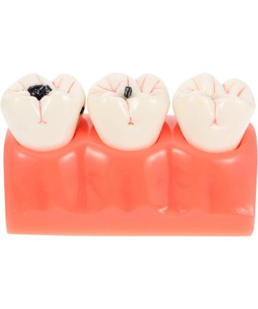 Ultechnovo Dental Recovery Tool Set - 2 Caries Tooth Models for Teaching & Demonstration | 12.5x7x6.5cm - Ideal for Dentistry Education - Buy Online on GoSupps.com