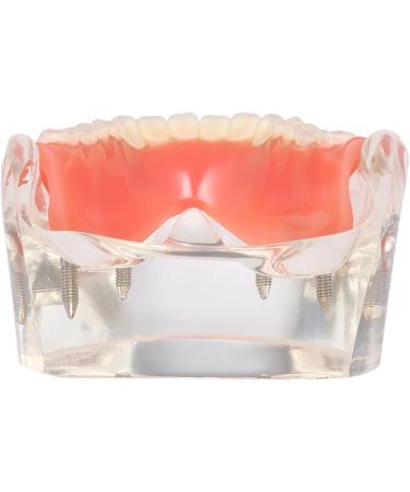 Samnuerly Dental Model with Down-Implant Deck - 4-Nail Teeth Demo for Teaching and Patient Communication | Transparent Educational Tool - Buy Online on GoSupps.com
