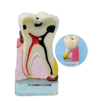 Dytah dental implant model - tooth pathology model - analysis crown bridge demonstration teeth model parodontal sortal teeth gums dental care for education
