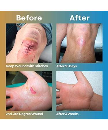 MEDIQUICK Wound Hydrogel Spray 4oz Bottle - First Aid Ointment for Cuts & Burns - Buy Online on GoSupps.com