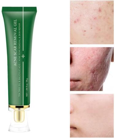 acne removal cream Acne Scar Removal Gel Face Body Marks Skin Repair Cream Acne Treatment Essence 30g - Buy Online on GoSupps.com