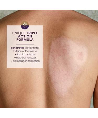 Mederma Skin Care for Scars 20g - Pack of 3 | Scar Treatment Cream - Effective & Affordable - Buy Online on GoSupps.com