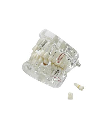 Buy Youya Transparent Dental Tooth Model for Dentists | Removable Pathological Teaching Model | International Shipping Available - Buy Online on GoSupps.com