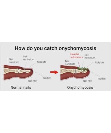 1PC Nail Treatment Nail Renewal Solution Toenails & Fingernails Nail Repairs Essential Oil Protects From Discoloration Brittle And Cracked Nail(12ML) 111 - Buy Online on GoSupps.com