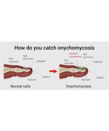 OnIUeZky 1 pc nail treatment nail renewal solution toenails and fingernails nail repairs essential oil protects against discoloration brittle and cracked nail 12 ml - Buy Online on GoSupps.com