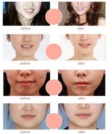 1PC Double Chin Mask Perfect V Lifting Premium Anti-celluite Mask For Facial Firming Treatment V Line Lifting 4D Face Mask Double Chin Reducer(White) 111 - Buy Online on GoSupps.com