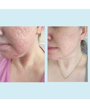 Glycolic Acid 50% Gel Peel - Enhanced with Retinol & Green Tea Extract (Professional Skin Peel)1 ounce 50% Strength - Buy Online on GoSupps.com