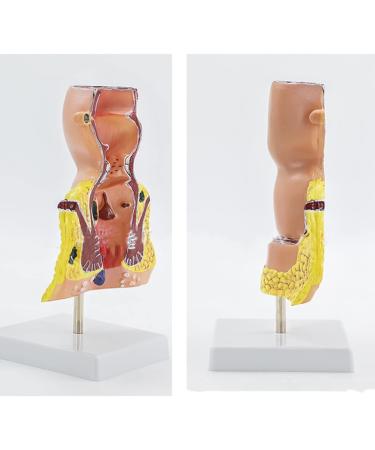 Human Anorectal Pathology Model Hemorrhoid Lesion Model Proctology Hemorrhoid Anal Fistula Lesion Model for Medical Teaching/Education Supplies - Buy Online on GoSupps.com