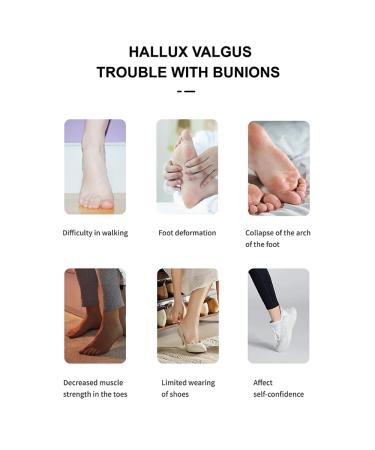 LUBYD Orthopedic Bunion Corrector for Women and Men - Adjustable Splint for Bunion Relief with Inner Silicone Pad - Day Night Support - Buy Online on GoSupps.com