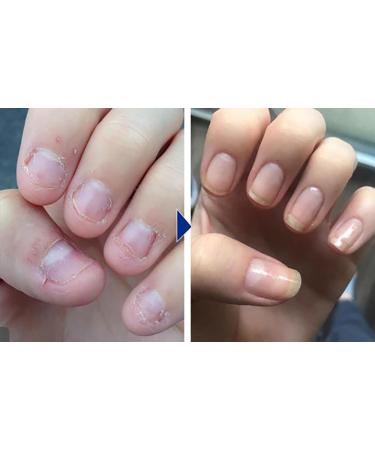 Biancat OnyxoGuard Nail Growth and Repair Serum OnyxoGuard Serum Nail Growth Serum Nail Growth and Strengthener Nail Serum Repair Essence Nail Strengthener for Thin Nails and Growth (2pcs) - Buy Online on GoSupps.com