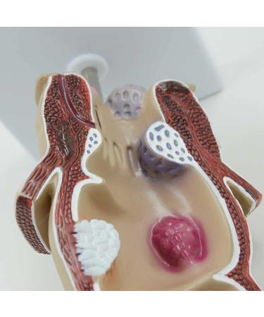 Humanly Rectal Hemorrhoid Lesions Anatomical Model Dilkpunkt Anal Anorectal - Buy Online on GoSupps.com