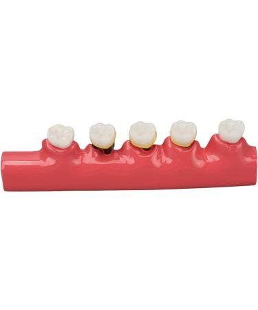 Realistic Dental Periodontitis Model - Study Dental Teeth in Various Stages | Synthetic Resin Educational Tool - Buy Online on GoSupps.com