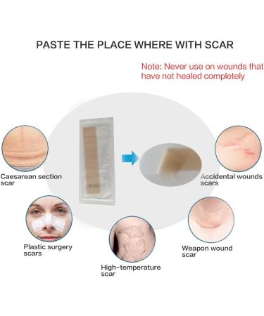 Longmed Silicone Scar Sheets for C-Section Keloid & Acne Scar Removal - 4 Pack 7 x 1.57 - Healing Strips & Sheets - Gel Tape & Cream Alternative - Buy Online on GoSupps.com