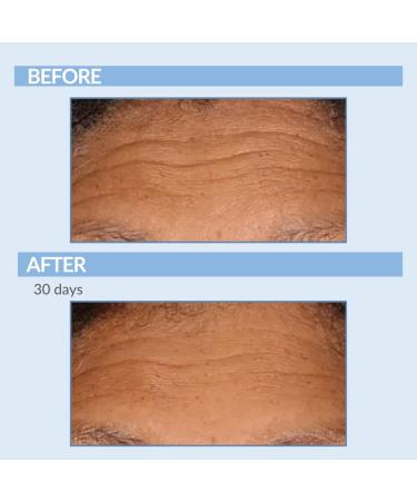 Retinol Fine Lines and Wrinkles Skin Care Set - A Force XR Serum and A Cream XR Moisture Cream for Face - Anti-Aging - Minimize Post Acne Marks - Resurface and Hydrate - Serious Skincare - Buy Online on GoSupps.com