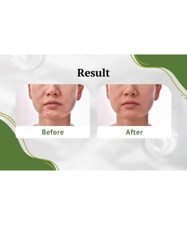 Shop Effective Pimple Patches Online | Fast International Shipping - Buy Online on GoSupps.com