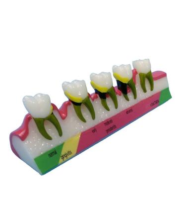 Dytah dental model dental teeth lessons for the standard demonstration for adult standard demonstration model periodontitis periodontital disease classification for studies and teaching