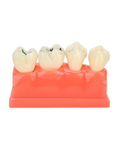 Ververt Touch toothing model dental caries model for school dental lessons demonstration model learning aid for dentists 180 mm