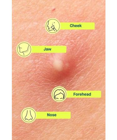 Hydrocolloid Acne Pimple Patch | 72 Fast Healing Dots | Vegan Cruelty-Free Spot Stickers for Zits & Blemishes - Skin & Face Care - Buy Online on GoSupps.com