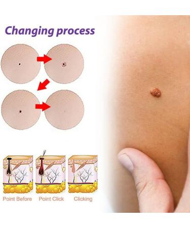 Skin Tag Removal Solution.(2PC 30ML) 2PC 30ml - Buy Online on GoSupps.com
