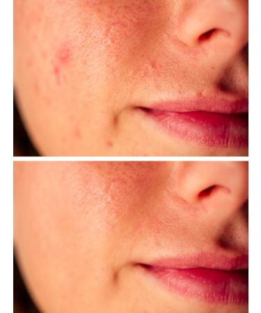 DrFormulas Foaming Face Wash for Oily Skin & Acne | Salicylic Acid Vitamin C & Tea Tree Oil - 5 oz - Buy Online on GoSupps.com