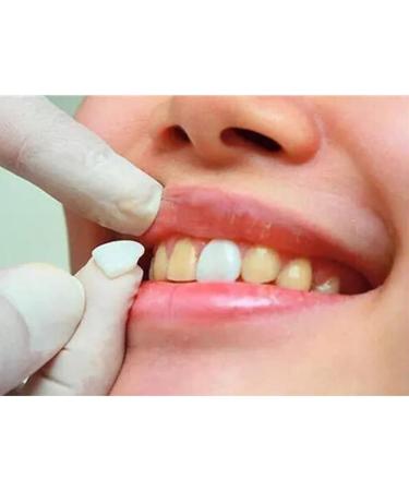 SowSmile Snap-On Smile Veneers for Instant Perfect Dental Care - Whitening Dentures - Buy Online on GoSupps.com