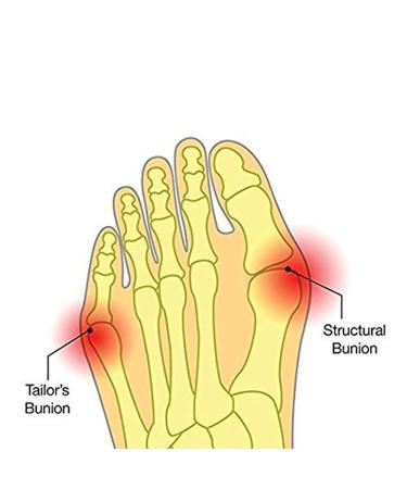 Higger Hallux Valgus Gel Pad Bunion Sleeves - Effective Bunion Relief Booties for Post-Operation Comfort - Wearable with Shoes - Buy Online on GoSupps.com