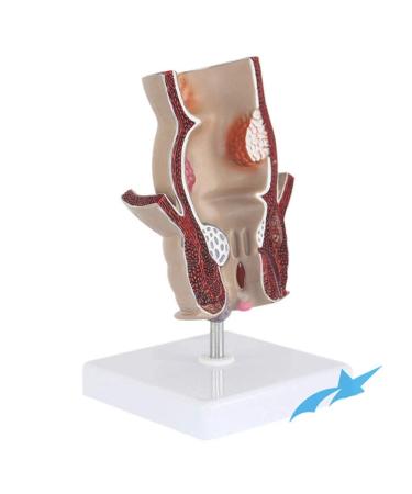 Rectum Model Human Pathological Diseases Rectum Ulcus Acne Pathological Model Use for Model Hemorrhoid Model Demonstration of Anorectal Diseases