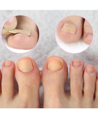 Nail Correction Stickers for Ingrown Toenails Relieve Pain Nail Treatment (50 count) - Buy Online on GoSupps.com