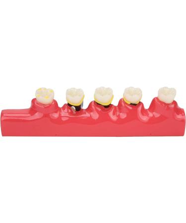 Dental Periodontitis Model | Periodontal Development Study Tool for Dental Research & Learning - Buy Online on GoSupps.com