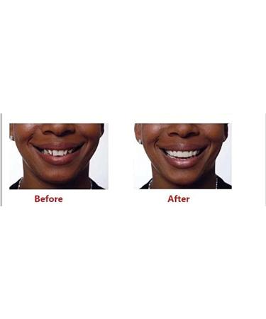 CHNLML Upper and Lower Veneer Dentures - Fake Teeth Natural Shade for Women and Men - Top and Bottom Veneers for Cosmetic Teeth - Protect Your Teeth - Buy Online on GoSupps.com