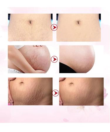 Effective Stretch Marks Removal Cream for Women Targets Pregnancy & Acne Marks Moisturizes & Firms Skin - Buy Online on GoSupps.com