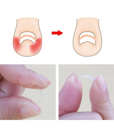 Ingrown Toenail Correction Kit Ingrown Toenail Patch Correction Kit Elastic Toe Nail Straightener Patch with Nail File Glue - Buy Online on GoSupps.com