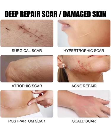  ZRREMRE Anti Scar Cream Repair Gel for Old and New Scars Face Scar Treatment Cream Surgical Scars Acne Scars Caesarean Section  - Buy Online on GoSupps.com