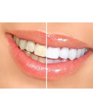 Smilebriter Teeth Whitening Gel Pens - Get a Bright White Smile - Buy Online on GoSupps.com