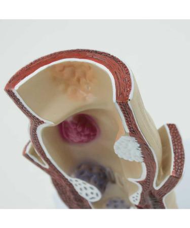 Humanly Rectal Hemorrhoid Lesions Anatomical Model Dilkpunkt Anal Anorectal - Buy Online on GoSupps.com