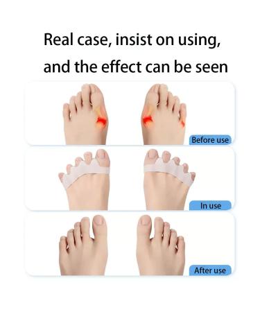 Samoka 6 PCS Gel Toe Separators for Bunion Correction and Toe Alignment - 3 Pairs (Blue/Pink/White) - Buy Online on GoSupps.com