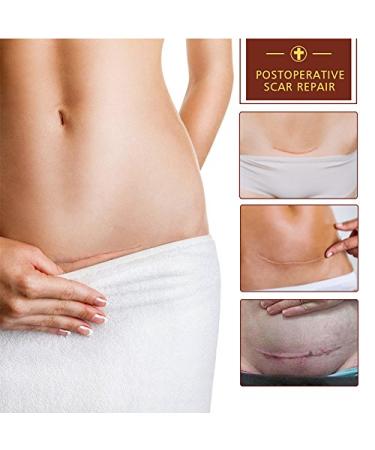 Scar & Acne Marks Removal Ointment Gel (2 Pack) - Skin Repair for Scars Burns Cuts Stretch Marks & Acne Spots - Effective Redness Cream for Face & Body - Buy Online on GoSupps.com