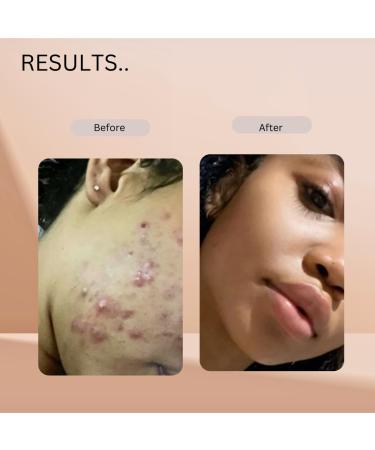 Pure Kojic Acid Soap Brighten Skin Fade Dark Spots & Even Skin Tone International Shipping Available - Buy Online on GoSupps.com