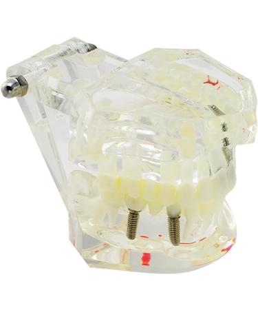 Denshine Dental Implant Disease Teeth Model - Restoration & Bridge Tooth for Dental Education & Training - Buy Online on GoSupps.com