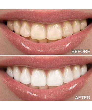 Novashine Professional Teeth Whitening Kit with Advanced Blue LED Light and Peroxide Gel - Smartphone Adapter and Travel Bag Included - Buy Online on GoSupps.com