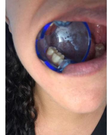 Buy Dental Orthodontic Lip Cheek Retractor Expander Mouth Opener - Autoclavable 15 Pieces Lot for Posterior Teeth - International Shipping Available - Buy Online on GoSupps.com