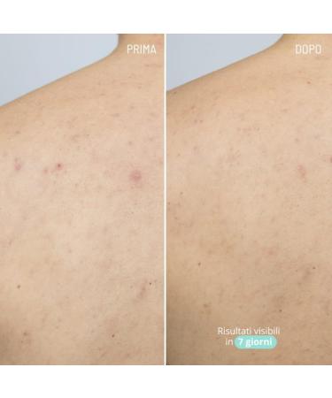 Freshly Cosmetics Azelaic Active Body Treatment Acne Serum 100ml - Buy Online on GoSupps.com