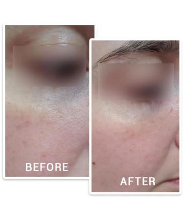 ZustBeauty 3-in-1 Derma Roller Kit with 0.3mm Titanium Microneedling Heads, Vitamin C Serum & Collagen Cream - Buy Online on GoSupps.com