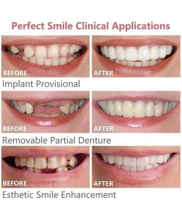 Brigtviee 2 Pairs of False Teeth Veneers Temporary Smile Dentures Upper and Lower Instant Whitening Dentures ClipIn Veneers for Men and Women Confident Smile - Buy Online on GoSupps.com