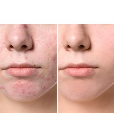 DrFormulas Foaming Face Wash for Oily Skin & Acne | Salicylic Acid Vitamin C & Tea Tree Oil - 5 oz - Buy Online on GoSupps.com