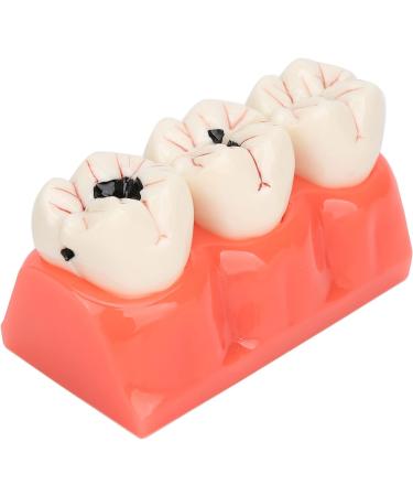 Verdant Touch Simulation Teeth Caries Model - Removable Tooth Caries Demonstration for Dental Education | International Shipping - Buy Online on GoSupps.com