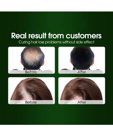 Hair Growth Shampoo Anti-Hair Loss Shampoo Shampoo for Thinning Hair and Hair Loss Strong Natural Organic Ingredients Repairs Damaged Scalp - Buy Online on GoSupps.com