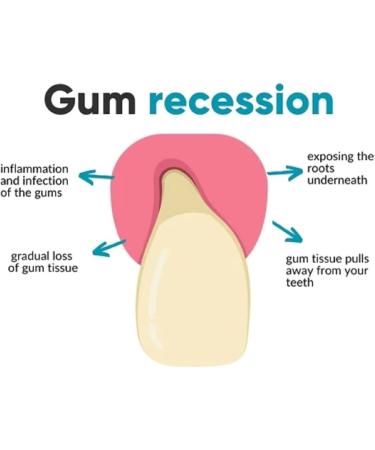 Lovilds Gum Therapy Gel for Repair & Clean - 2PCs | International Shipping | Tooth Stain Remover - Buy Online on GoSupps.com