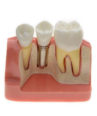 Dental Implant Interpretation Model Implant Analysis Crown Bridge Demonstration Model Teeth Model